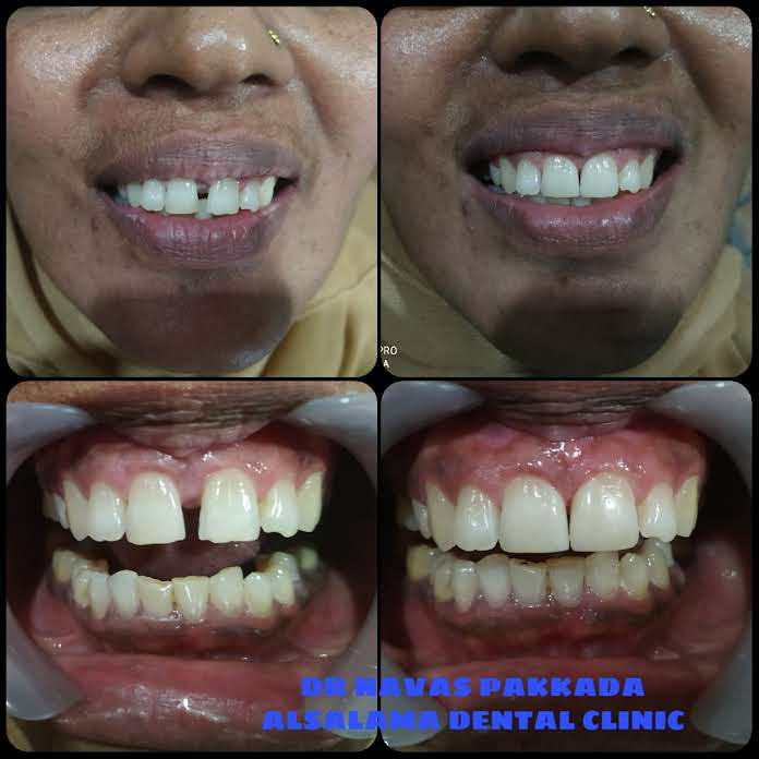 Midline diastema closure